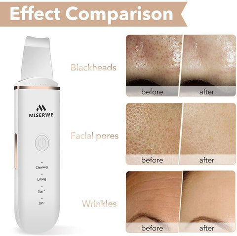 Skin Shovel Machine – Revitalize Your Skin Effortlessly!